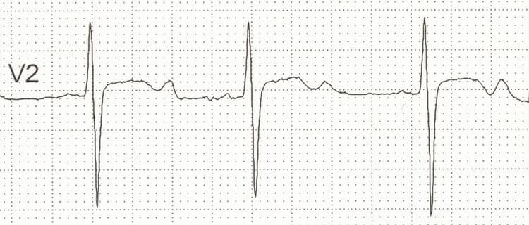 Figure 3. Hypokalemia.