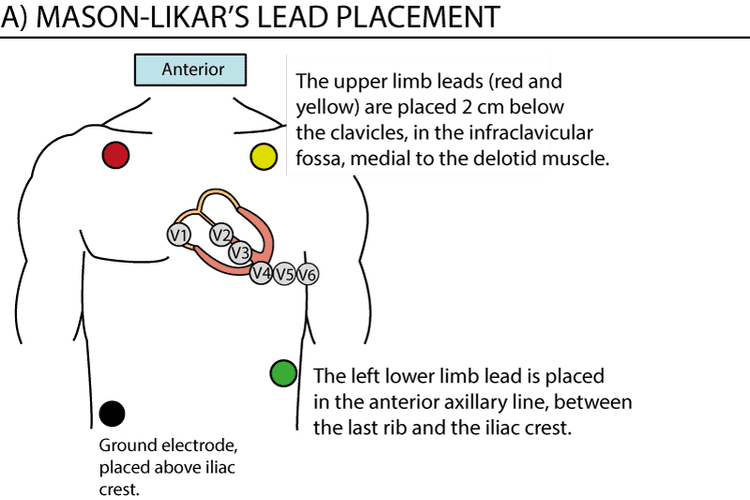 Figure 1. Lead placement for exercise ECG. Note that the precordial (chest) leads are placed normally. The limb leads are relocated to the torso, or proximally on the limbs. The lead placement depicted here is referred to as Mason-Likar