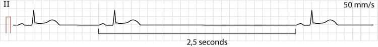 Figure 1. Sinoatrial arrest. Also note the ST-segment elevations (which in this case has no relation to the sinoatrial arrest).
