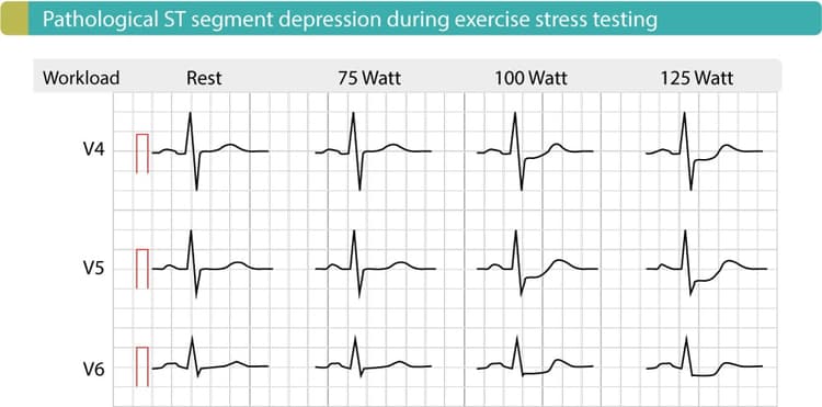 Figure 5. Exercise ECG in patient with coronary artery disease shows significant ST depressions in J-60 point, J-80 point. These depressions become more pronounced as workload increases. This test was performed on bicycle.