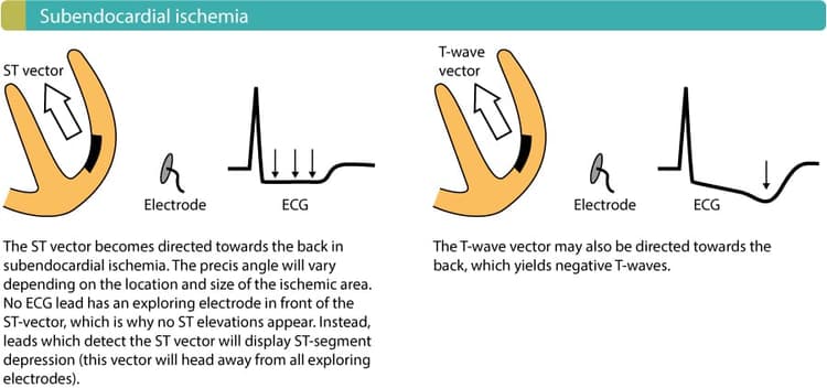 Figure 1. Exercise causes subendocardial ischemia and thus ST segment depression on the ECG.