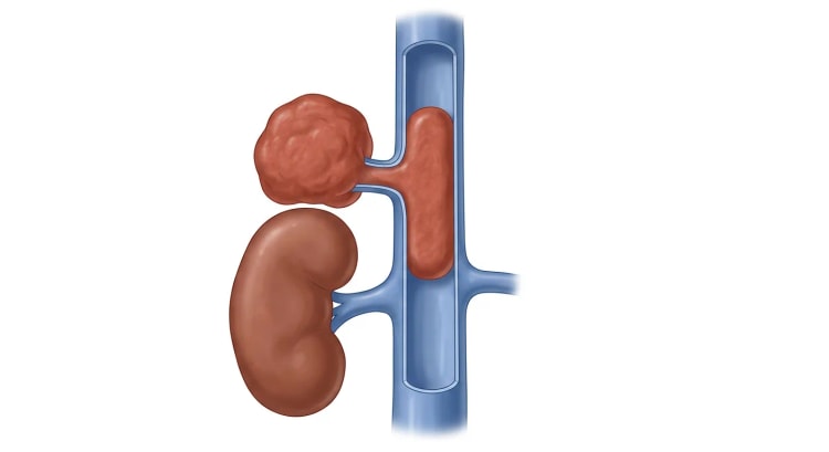 Tegnet frontalbillede af en knoldet tumor over højre nyres øvre pol, forbundet med vena cava inferior via en kort binyrevene. Karrets forvæg er fjernet, så en solid tumorprop ses inde i lumen, med åbent karlumen over og under proppen.
