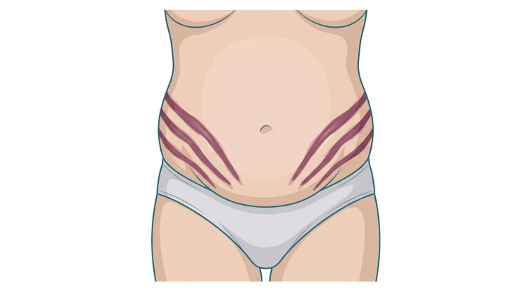 Tegnet nedre truncus set forfra hos en person med abdominal fedme. På begge flanker og den nedre del af abdomen ses flere brede, rødviolette striae i parallelle, skråt nedadgående bånd.