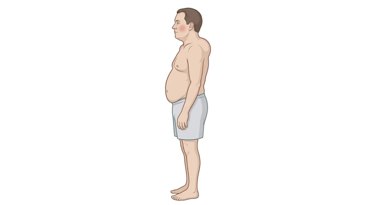 Tegnet mand i profil med rundt, fyldigt ansigt og rødmende kind, kort og bred hals, tung central abdominal fedme samt påfaldende tynde arme og ben.