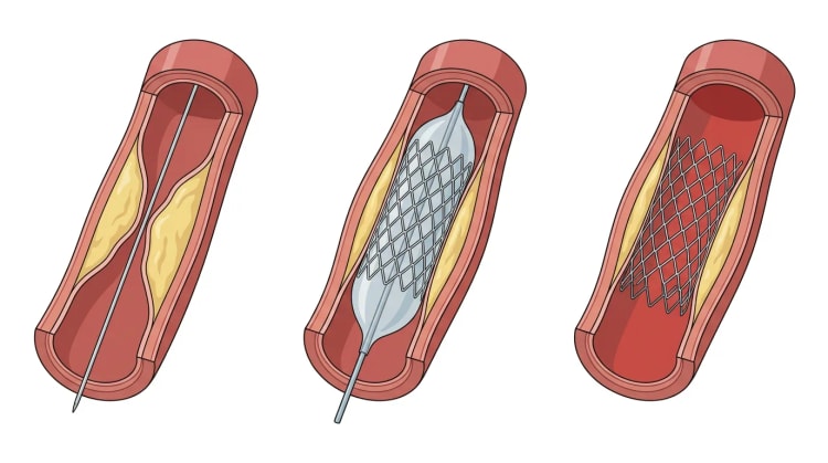 Tre opskårne koronararteriesegmenter, der viser stenose med guidewire, oppustet ballon med stent og efterladt ekspanderet stent.
