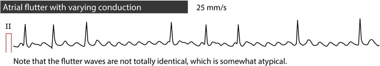 Figur 3. Atrieflagren med varierende AV-blok.