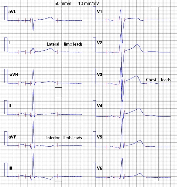 Figur 3. Cabrera-formatet og inverteret aVR.