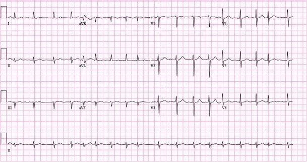Figur 5. Eksempel på 12-afledningers EKG med atrieflimren. Papirhastighed: 25 mm/s.