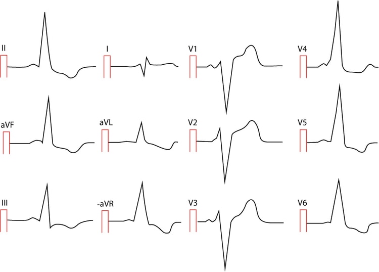Figur 2. Præeksitation hos en 25-årig kvinde. Der er mange afledninger, der viser ST-segmentdepression og T-bølgeinversion. Der er et meget kort PR-interval, brede QRS-komplekser og deltabølger i mange afledninger. Kan du spotte dem?