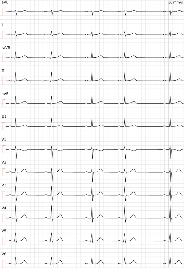 Figur 1. Sinusarytmi (respiratorisk sinusarytmi).