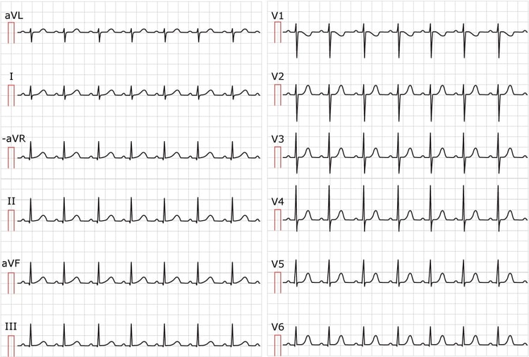 Figur 1. EKG, der viser sinustakykardi. Papirhastighed 25 mm/s. Beregn hjertefrekvensen ved at dividere 300 med antallet af store felter mellem R-bølgerne. Der er ca. 3 store felter mellem R-bølgerne; 300/3 svarer til 100 slag pr. minut.