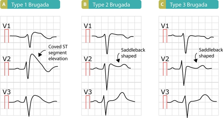 Figur 10. De tre typer Brugada-syndrom og de karakteristiske ST-segmentforhøjelser.