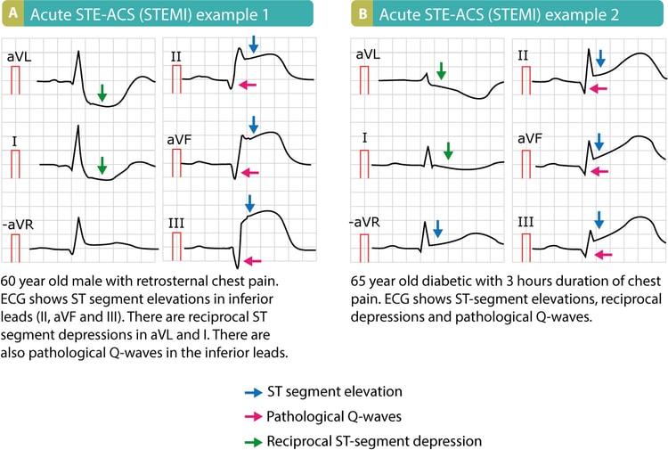 Figur 3. Eksempler på STE-ACS (STEMI). Bemærk, at disse patienter havde patologiske Q-bølger, hvilket betyder, at disse EKG'er blev optaget flere timer efter symptomdebut, eller at de er tegn på et gammelt infarkt.