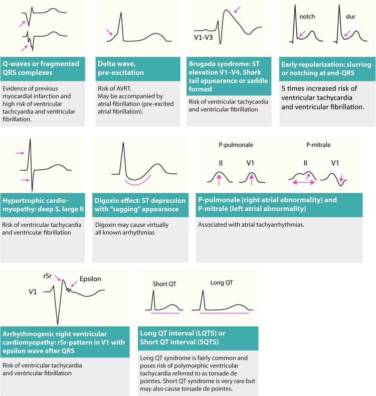 Figur 3. Ændringer på hvile-EKG, som kan afsløre årsagen til arytmier (arytmisubstrater).