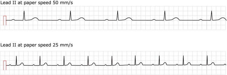 Figur 1. EKG ved førstegrads AV-blok. Begge konventionelle papirhastigheder vises.