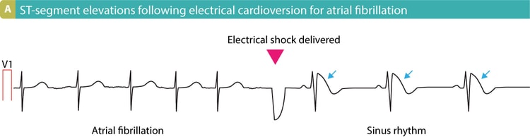 Figur 12. Elektrisk kardioversion, der resulterer i ST-segmentforhøjelser.