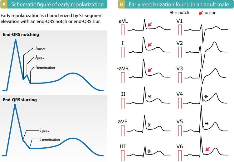 Figur 1. Tidligt repolarisationsmønster på EKG. Bemærk end-QRS-hak og slur samt ST-segmentets forhøjninger.