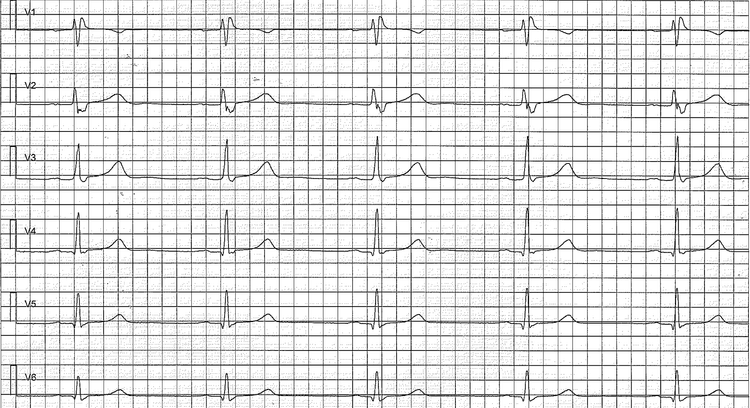 Figur 2. Brystafledninger (prækordiale) med tidligt repolarisationsmønster. Denne patients bror døde af pludseligt hjertestop i en alder af 29 år. Bemærk det inkomplette højre grenblok (RBBB).