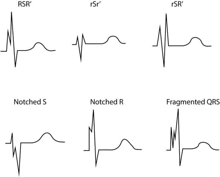 Figur 2. Fragmenteret QRS-kompleks. Disse QRS-konfigurationer er også tegn på tidligere myokardieinfarkt.
