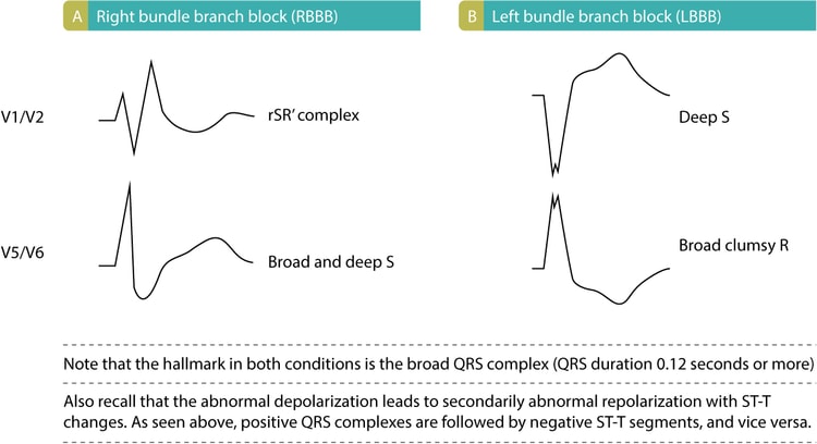 Figur 2. Karakteristika for bundtgrenblokke. (A): EKG-karakteristika ved højre grenblok (RBBB). (B): EKG-kendetegn ved grenblok i venstre bundt (LBBB).