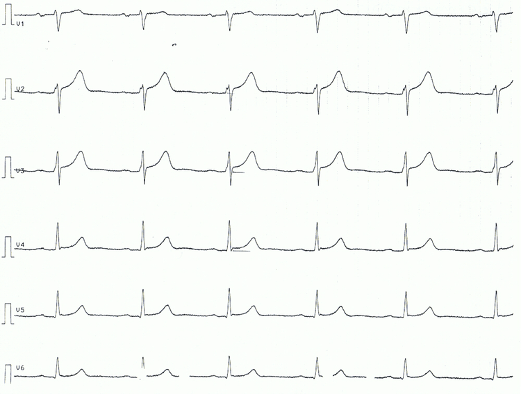 Figur 3. Brystafledninger hos en patient med akut perikarditis. Bemærk ST-segmentforhøjelserne og de konkave ST-segmenter.