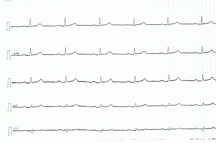 Figur 4. Ekstremitetsafledninger hos en patient med akut perikarditis. Bemærk de meget diskrete, men generaliserede ST-segmentforhøjelser, konkave ST-segmenter.