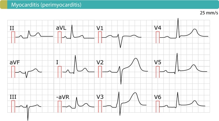 Figur 2. EKG ved akut perikarditis (myokarditis, perimyokarditis). Som det fremgår, er der generaliserede ST-segmentforhøjelser. Der er ingen reciprokke ST-segment-sænkninger og ingen samtidige T-bølge-inversioner (negative T-bølger).