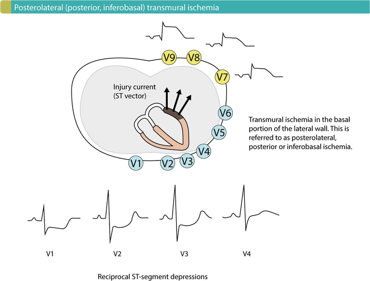 Figur 1. Posterolateral (posterior, inferobasal) transmural iskæmi forårsager reciprokke ST-segment-sænkninger i V1-V3 (lejlighedsvis V4). Afledningerne V7-V9 skal placeres for at afsløre ST-segmentforhøjelserne.