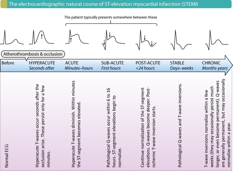 Figur 2. Det elektrokardiografiske naturlige forløb ved STEMI (ST-elevation myokardieinfarkt).