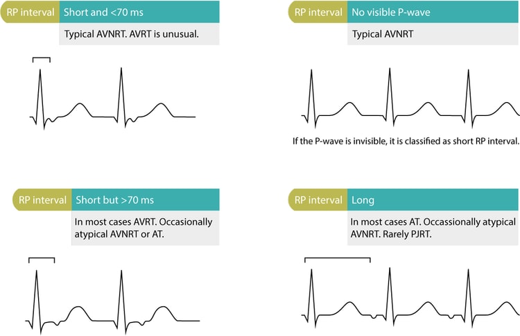 Figur 2. Differentialdiagnoser baseret på RP-interval.
