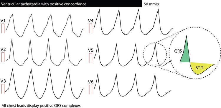 Figur 7. Overensstemmelse i QRS-komplekser fra V1 til V6 ved ventrikulær takykardi.