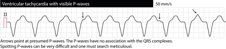 Figur 1 (gentaget). Monomorf ventrikulær takykardi (VT, VTach). P-bølger er synlige, men de har ikke nogen relation til QRS-komplekserne. Denne situation kaldes "AV-dissociation" og indikerer, at atrie- og ventrikelaktivitet er uafhængige. AV-dissociation bekræfter, at arytmien er ventrikulær takykardi. AV-dissociation er dog ofte svær at få øje på.