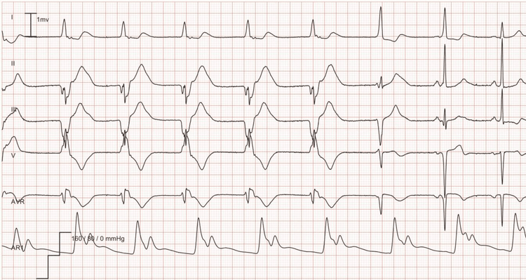 EKG-eksempel: Idioventrikulær rytme (accelereret ventrikulær rytme) - Accelereret ventrikulær rytme med en hastighed på 56 i de første 5 slag efterfulgt af 2 fusionsslag; de sidste 2 slag er normal sinusrytme.