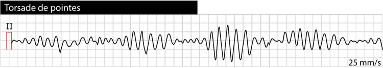 Figur 2. Torsade de pointes (polymorf ventrikulær takykardi) forårsaget af lang QT-syndrom.