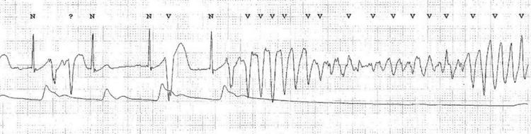 EKG, der viser en episode med sinusrytme (med flere ventrikulære præmature slag), som spontant konverterer til Torsade de Pointes ventrikulær takykardi. Bemærk, hvordan det arterielle blodtryk (ABP) falder ved begyndelsen af TdP. EKG af Nakstad et al (Scand J Trauma Resusc Emerg Med. 2010; 18: 7)