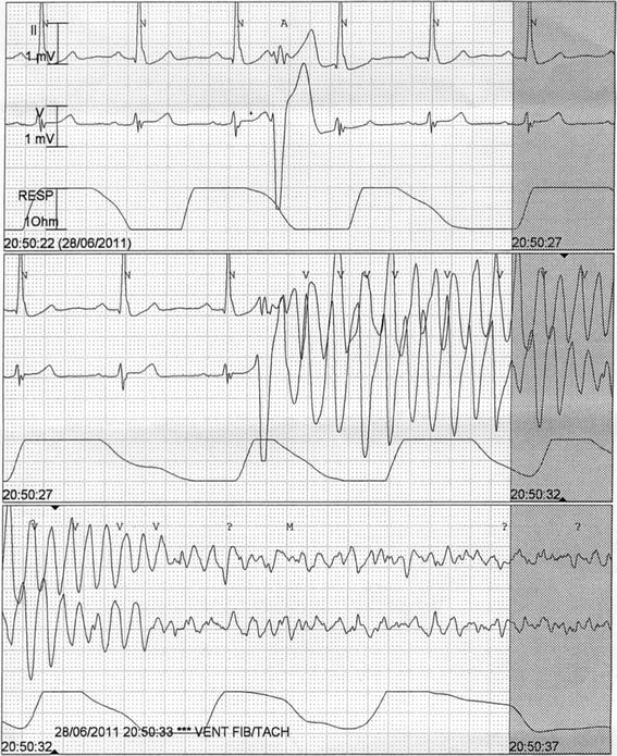 EKG, der viser polymorf ventrikulær takykardi, der degenererer til ventrikelflimren. Af Bagnall et al: BMC Medical Genetics 15 (2014): 99.
