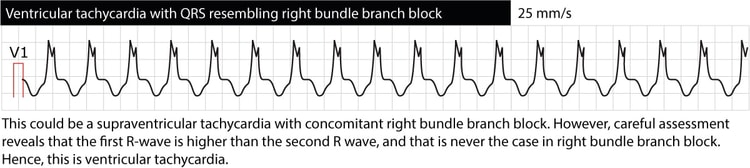Figur 4. Ventrikulær takykardi med morfologi af højre grenblok (RBBB). Den første R-bølge er dog større end den anden R-bølge, hvilket ikke er tilfældet ved RBBB. Dette tyder på, at rytmen ikke er en supraventrikulær takykardi overledt med RBBB, men snarere ventrikulær takykardi (VT).