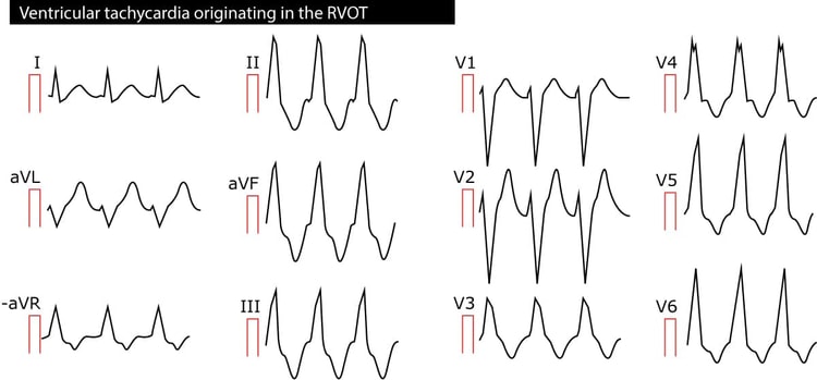 Figur 2. Ventrikulær takykardi (VT) med udspring i den højre ventrikels udstrømningskanal (RVOT).