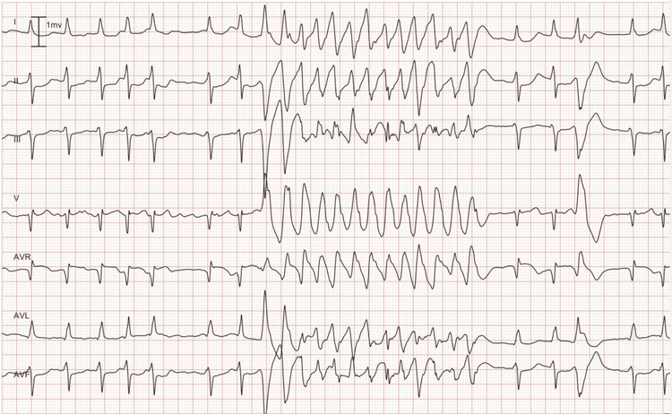 Figur 8. Afledning I, II, III, V1 aVR, aVL og aVF. Som det ses i begyndelsen af optagelsen, har patienten en underliggende rytme af atrieflimren. Atrieflimmeren afbrydes af en hurtig og regelmæssig takykardi med bredt QRS-kompleks. Det fjerde slag fra slutningen er et præmaturt ventrikelslag, og dets QRS-morfologi er identisk med den QRS, der ses under takykardien. Derfor stammer takykardien også fra ventriklerne, hvilket indebærer, at det er ventrikulær takykardi (VT).
