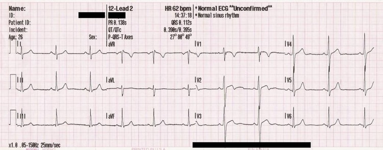 Figur 1. Den traditionelle præsentation af afledningerne i 12-afledningers EKG.
