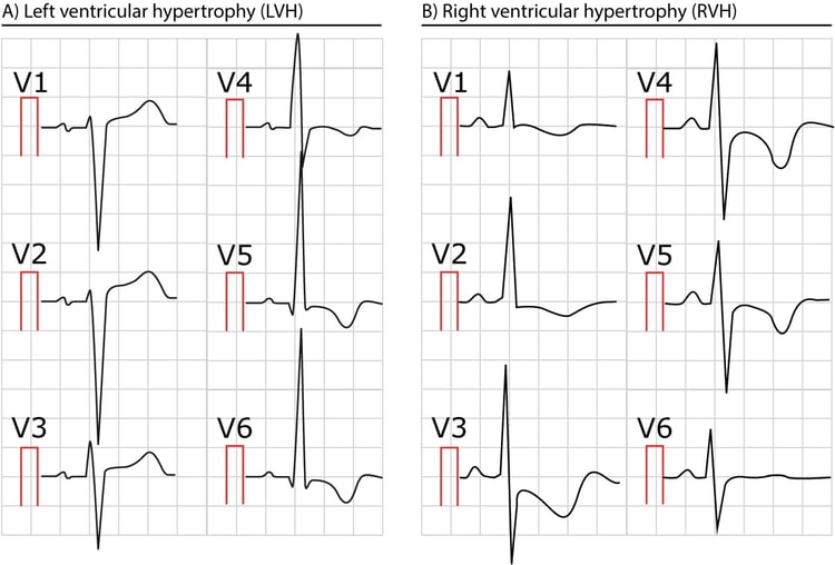 Figur 2. To EKG'er, der viser venstre og højre ventrikelhypertrofi.