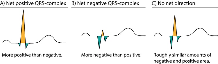 Figur 6. Tilnærmelser til QRS-kompleksets nettoretning. De positive områder er gule, og de negative områder er grønne