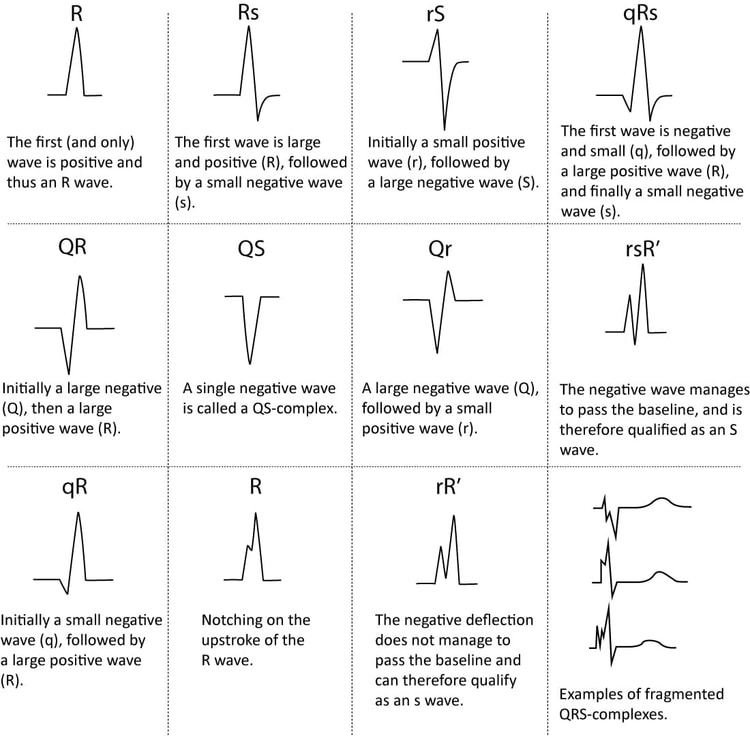 Figur 5. Navngivning af QRS-komplekset.