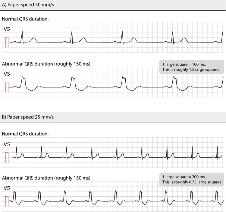 Figur 8. Normale og unormale QRS-varigheder ved forskellige papirhastigheder