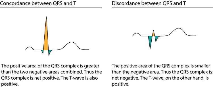 Figur 1. Diskordans og konkordans mellem QRS-kompleks og ST-T-segment.