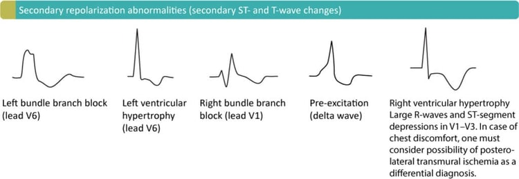 Figur 4. Sekundære ST-T-forandringer på grund af LBBB (venstre grenblok), LVH (venstre ventrikelhypertrofi), RBBB (højre grenblok), præeksitation (WPW-syndrom) og RVH (højre ventrikelhypertrofi).