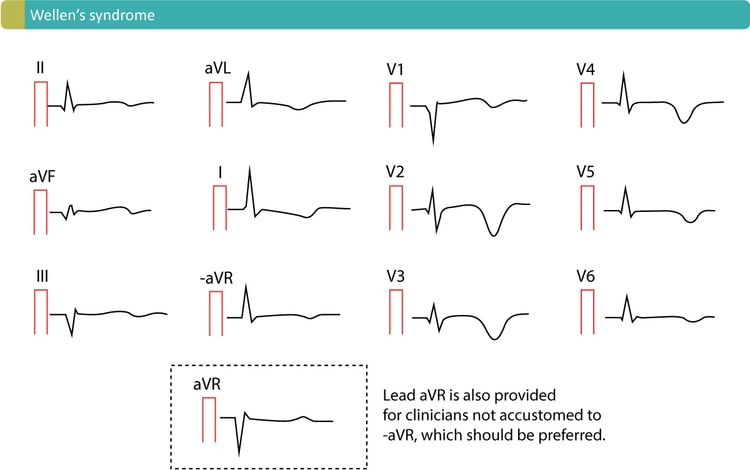 Figur 3. Karakteristiske T-bølge-inversioner forårsaget af Wellen's syndrom. Dette EKG-mønster kaldes almindeligvis Wellen's tegn.