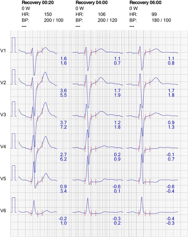 Figur 10. EKG-reaktion i brystafledninger under restitution.