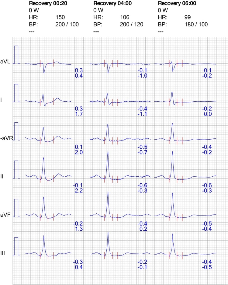 Figur 8. EKG-reaktion i ekstremitetsafledninger under restitution.