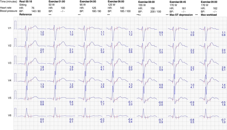 Figur 9. EKG-reaktion i brystafledninger under træning.